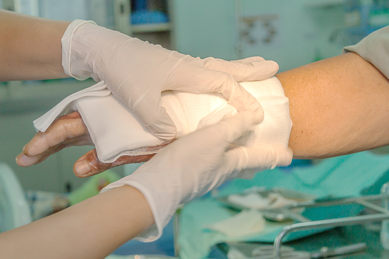 How To Prevent Scarring After A Burn Injury